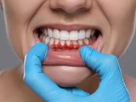 Scientists discover new way to prevent gum disease without killing good bacteria, study finds