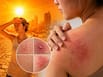 Heatwave skin alert: From heat rash to infections, how extreme summer heat damages your skin