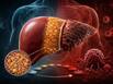 Can fatty liver turn into cancer? Doctor explains how the silent disease damages your liver
