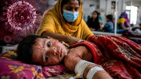 Not Ebola but deadly Measles is sweeping through Bangladesh: 500 dead, over 60,000 infected in the latest 2026 outbreak - Check symptoms and other details