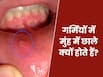 गर्मियों में भर गए हैं मुंह में छाले? डॉक्टर ने बताए इसके कारण और कम करने के नुस्खे