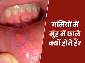 गर्मियों में भर गए हैं मुंह में छाले? डॉक्टर ने बताए इसके कारण और कम करने के नुस्खे