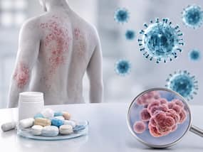 Past infections, not psoriasis drugs, may be the biggest predictor of future infection risk: BADBIR study