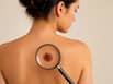 Chinese scientists sound alarm over massive global skin cancer surge by 2050: Prevention tips you should know