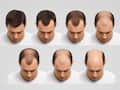 Stages of male baldness: 7 Norwood Scale levels that define hair loss progression