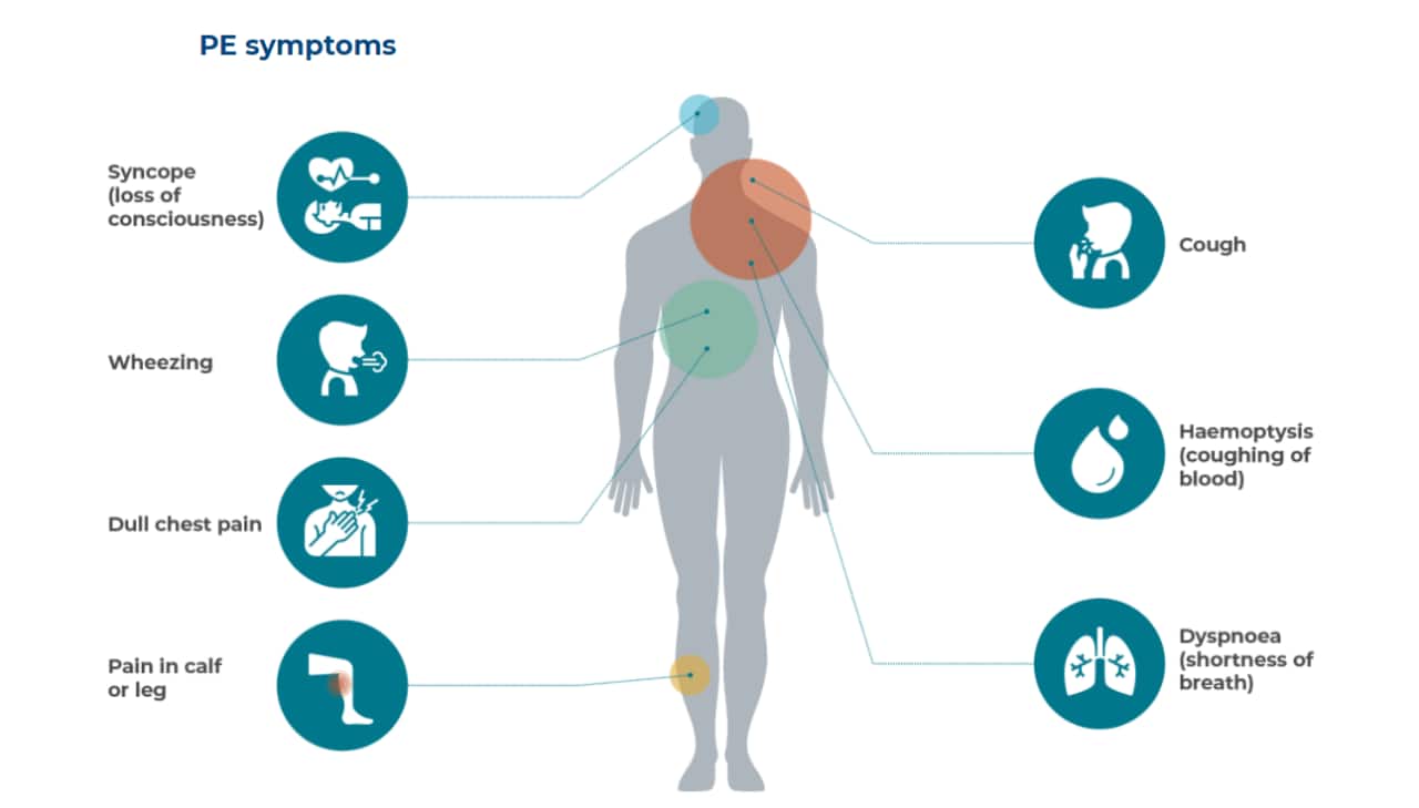 Symptoms of pulmonary embolism