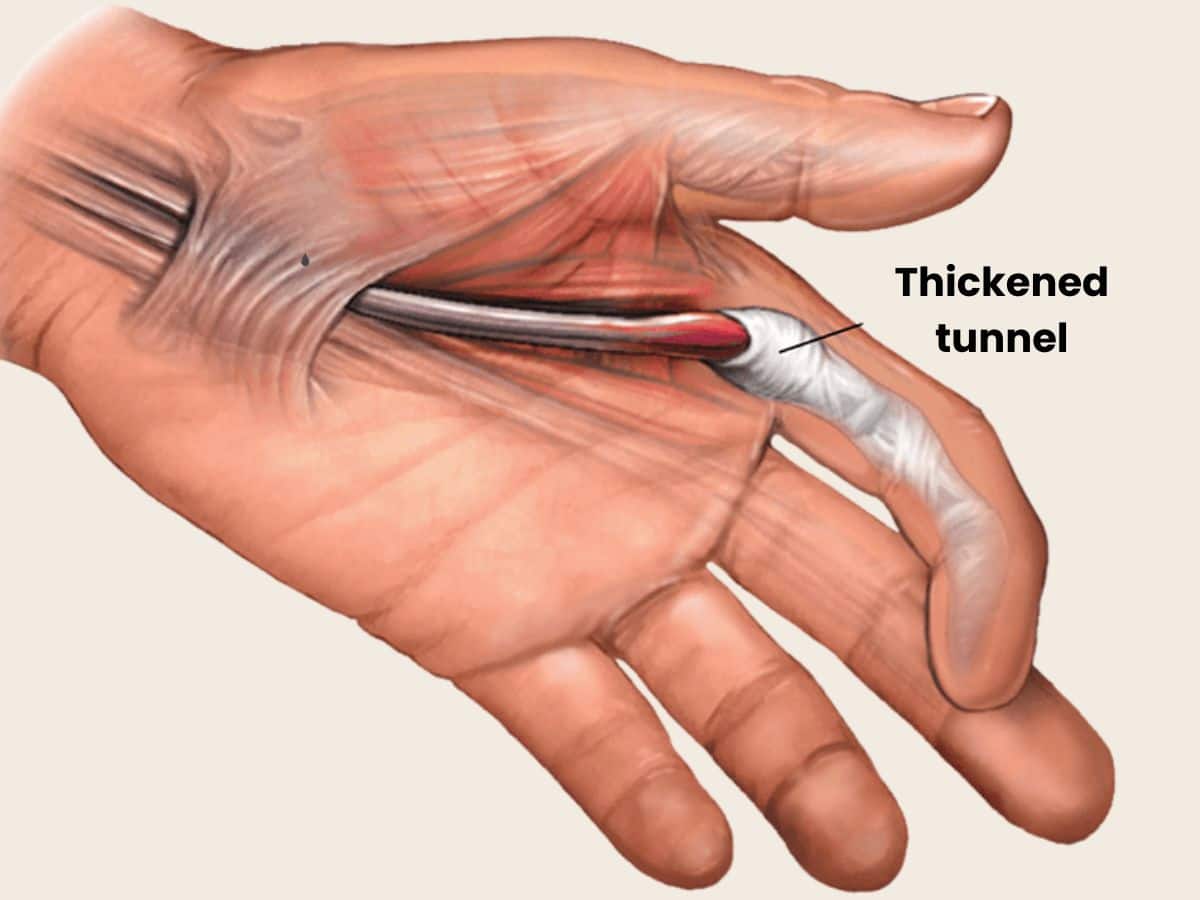 Trigger Finger