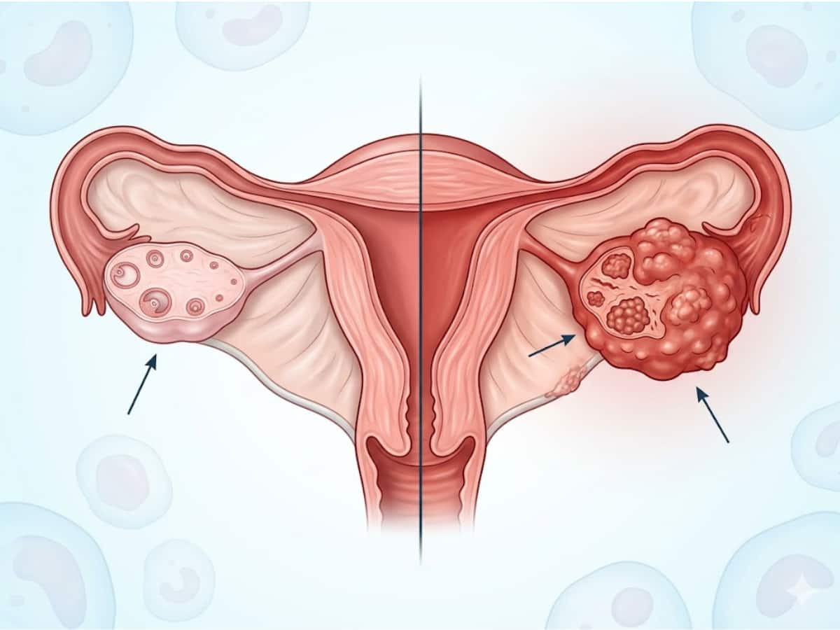 Normal ovary vs cancerous ovary