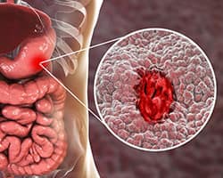 Upper GI bleeding