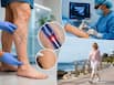 Varicose veins treatment has changed: How stitch-free procedures offer faster recovery and less pain