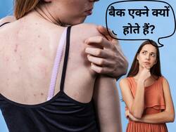 गर्मियों में कंधे और पीठ पर दाने क्यों हो जाते हैं? एक्सपर्ट से जानें कारण और उपाय