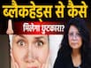 ब्लैकहेड्स हटाने के टिप्स, जानें कारण और स्किन को साफ रखने का तरीका!