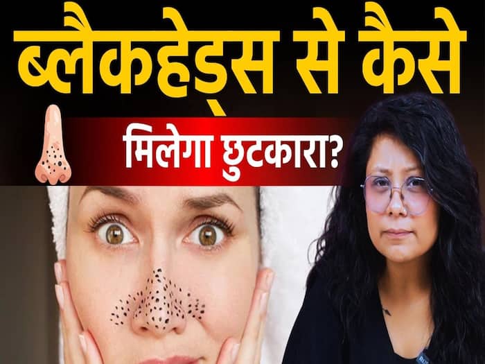 ब्लैकहेड्स हटाने के टिप्स, जानें कारण और स्किन को साफ रखने का तरीका!