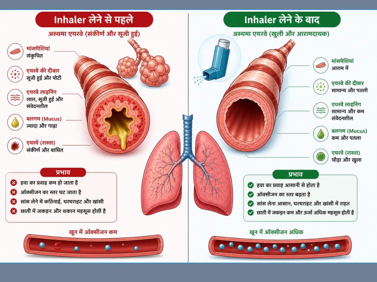 inhaler in asthma
