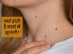 क्या मस्से में खुजली होना नॉर्मल है? डॉक्टर से जानें कारण और इलाज