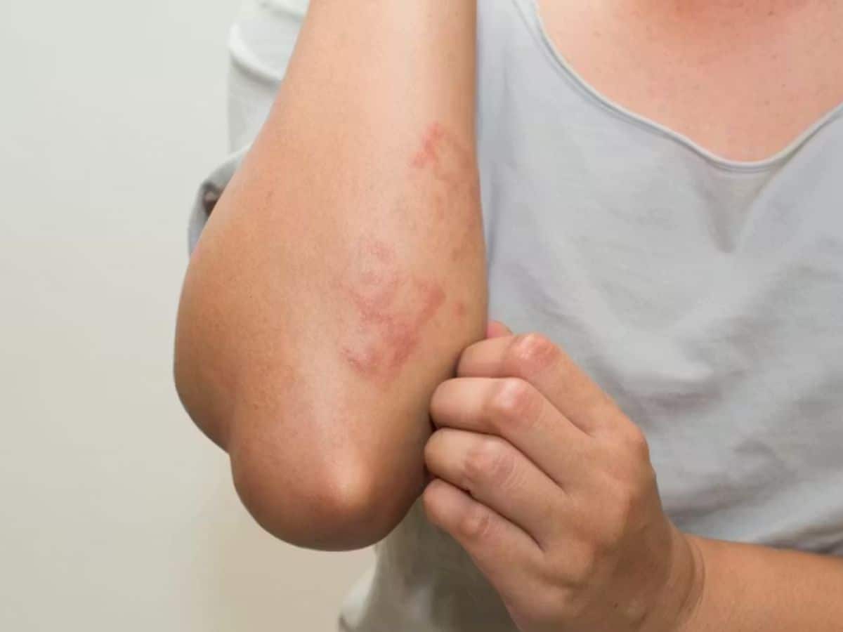skin rashes