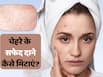 गर्मी की वजह से चेहरे पर हो रहे हैं छोटे-छोटे सफेद दाने, तो ये 5 घरेलू उपाय आएंगे काम