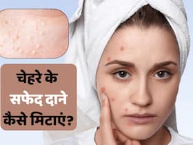 गर्मी की वजह से चेहरे पर हो रहे हैं छोटे-छोटे सफेद दाने, तो ये 5 घरेलू उपाय आएंगे काम
