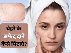 गर्मी की वजह से चेहरे पर हो रहे हैं छोटे-छोटे सफेद दाने, तो ये 5 घरेलू उपाय आएंगे काम