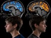 Autism may exist in two distinct forms, brain scans suggest