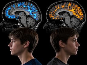 Autism may exist in two distinct forms, brain scans suggest