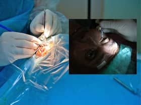 Cataract prevention: Eye doctor shares 6 daily habits to protect your vision and reduce cataract risk