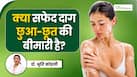 क्या सफेद दाग छूने से फैलता है? जानिए विटिलिगो से जुड़े इस मिथक के बारे में