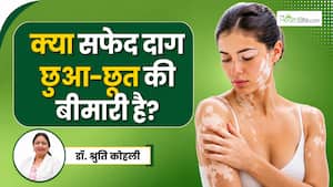 क्या सफेद दाग छूने से फैलता है? जानिए विटिलिगो से जुड़े इस मिथक के बारे में