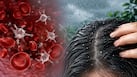 Dandruff during monsoon explained: What causes seasonal flare-ups?