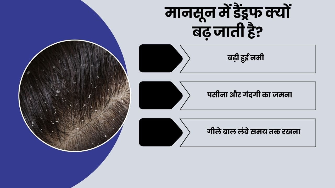 Dandruff in Monsoon