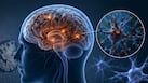 Excess iron in the brain may raise Alzheimer’s and Parkinson’s risk, study warns