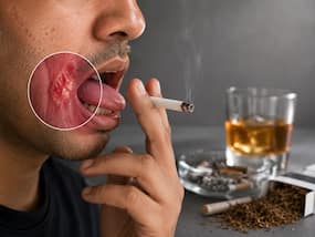 How tobacco and alcohol drive 62% of mouth cancer cases in India: Expert insights