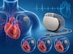 Pacemaker implantation explained: When you need one, how it works and types of pacemakers