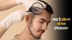सिर में फंगल इंफेक्शन कितना खतरनाक हो सकता है? जानें कब डॉक्टर को दिखाने की है जरूरत