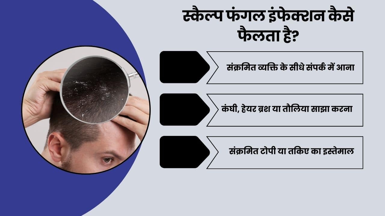 Scalp Fungal infection Causess