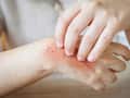 Skin infections during heat: Prevention and care that actually works