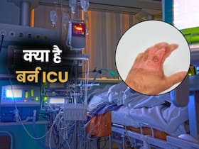 बर्न ICU क्या होता है? डॉक्टर बता रहे हैं गंभीर मरीजों का कैसे होता है इलाज