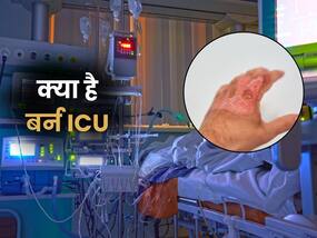 बर्न ICU क्या होता है? डॉक्टर बता रहे हैं गंभीर मरीजों का कैसे होता है इलाज