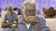 What is Smurf syndrome? The rare disease that can turn your skin blue or grey