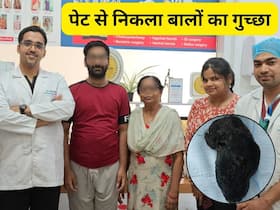युवक को थी बाल खाने की आदत, पेट से निकला गुच्छा, ट्राइकोबेजोअर की सफल सर्जरी से मिली राहत
