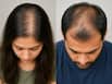 बालों की डेंसिटी कम होने का क्या कारण होता है?