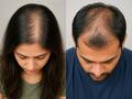 बालों की डेंसिटी कम होने का क्या कारण होता है?