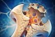 Osteoporosis in men under 50: Persistent back pain, stress fracture and other signs of weak bones that could signal a serious problem