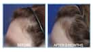 5 alternatives to spironolactone to reverse hair loss