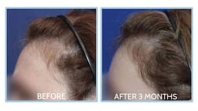 5 alternatives to spironolactone to reverse hair loss