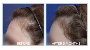 5 alternatives to spironolactone to reverse hair loss