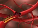 Fasting blood cholesterol spike: 5 signs your LDL level is completely out of control