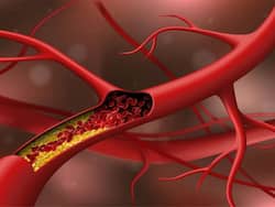 Fasting blood cholesterol spike: 5 signs your LDL level is completely out of control