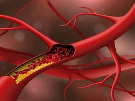 Fasting blood cholesterol spike: 5 signs your LDL level is completely out of control