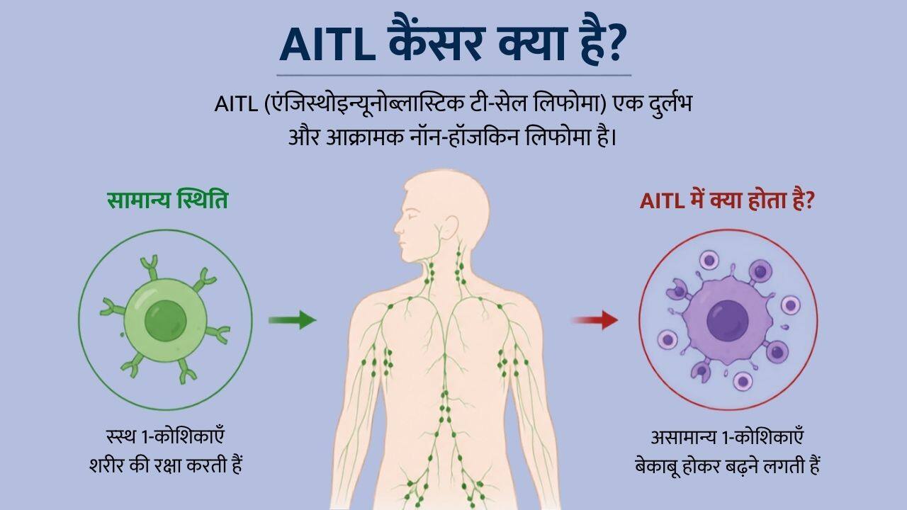 AITL कैंसर क्या है? (Image Credit- ChatGPT)